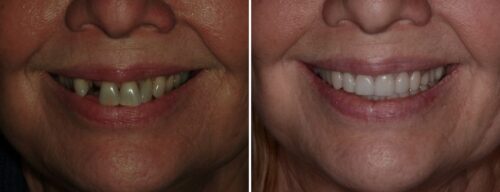 Results after dentistry at AH Smiles