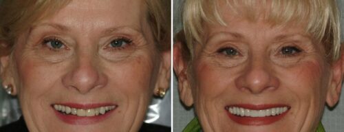 Results after dentistry at AH Smiles