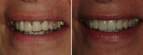 Results after dentistry at AH Smiles