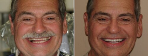 Results after dentistry at AH Smiles