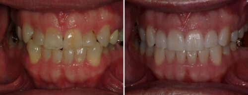 Results after dentistry at AH Smiles