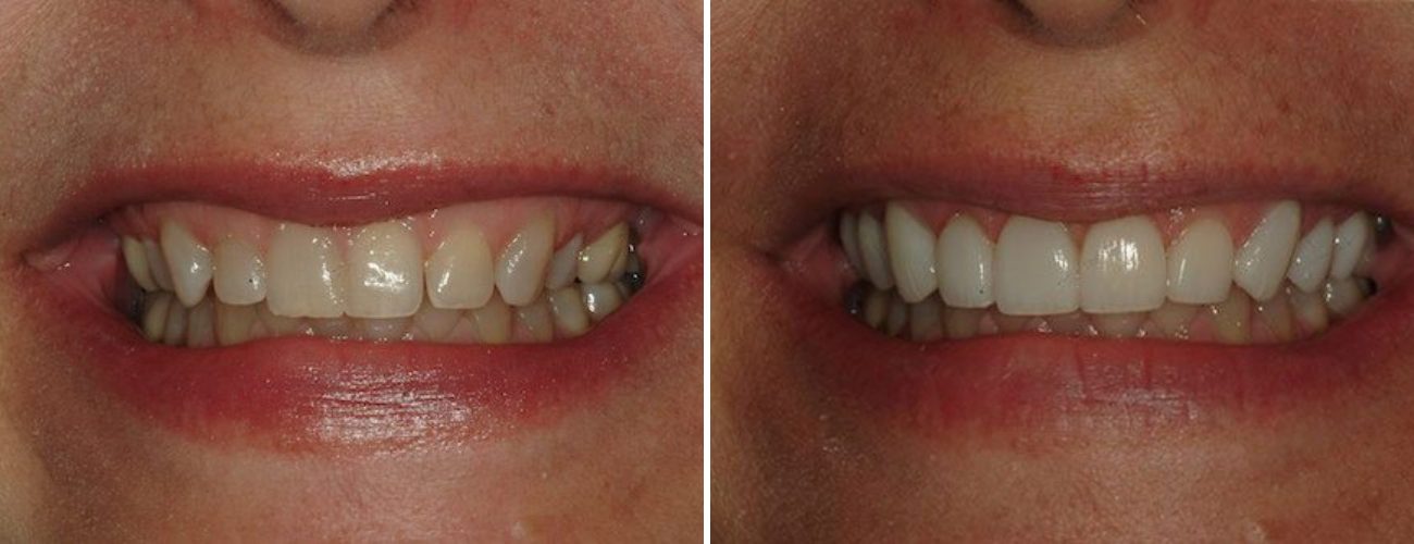 Dental patient before and after restorative dentistry