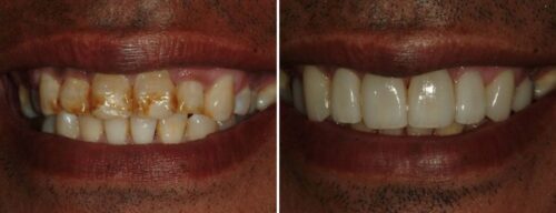 Results after dentistry at AH Smiles