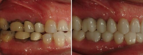 Results after dentistry at AH Smiles