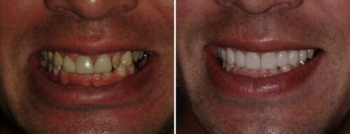 Results after dentistry at AH Smiles