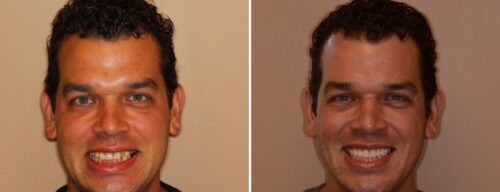 Results after dentistry at AH Smiles