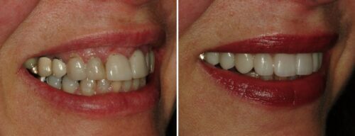 Results after dentistry at AH Smiles