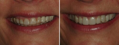 Results after dentistry at AH Smiles