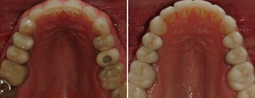 Results after dentistry at AH Smiles