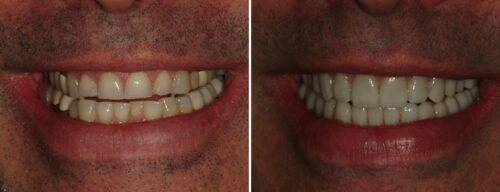 Results after dentistry at AH Smiles