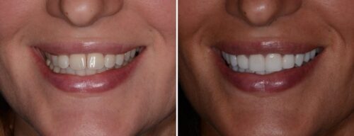 Results after dentistry at AH Smiles