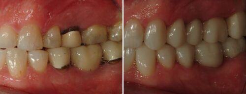 Results after dentistry at AH Smiles