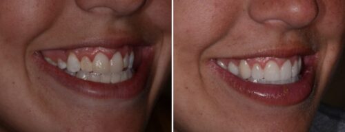 Results after dentistry at AH Smiles