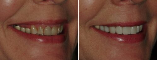 Results after dentistry at AH Smiles