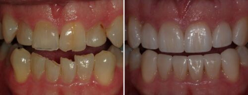 Results after dentistry at AH Smiles