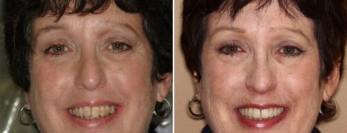 Results after dentistry at AH Smiles