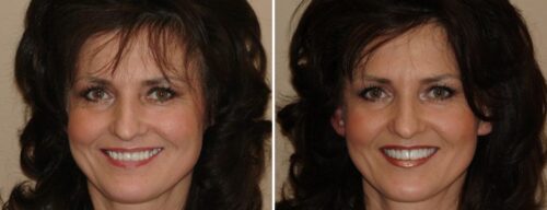 Results after dentistry at AH Smiles