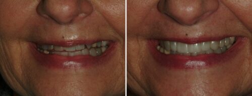 Results after dentistry at AH Smiles