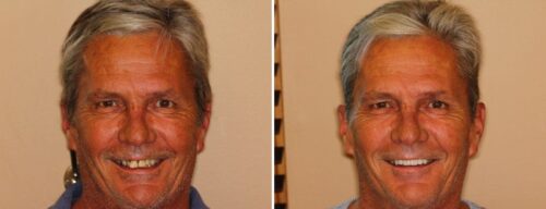 Results after dentistry at AH Smiles