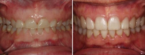 Results after dentistry at AH Smiles