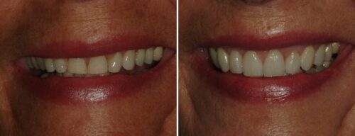 Results after dentistry at AH Smiles