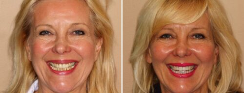 Results after dentistry at AH Smiles