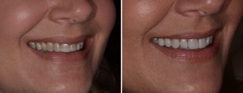 Results after dentistry at AH Smiles