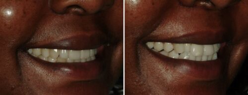 Results after dentistry at AH Smiles