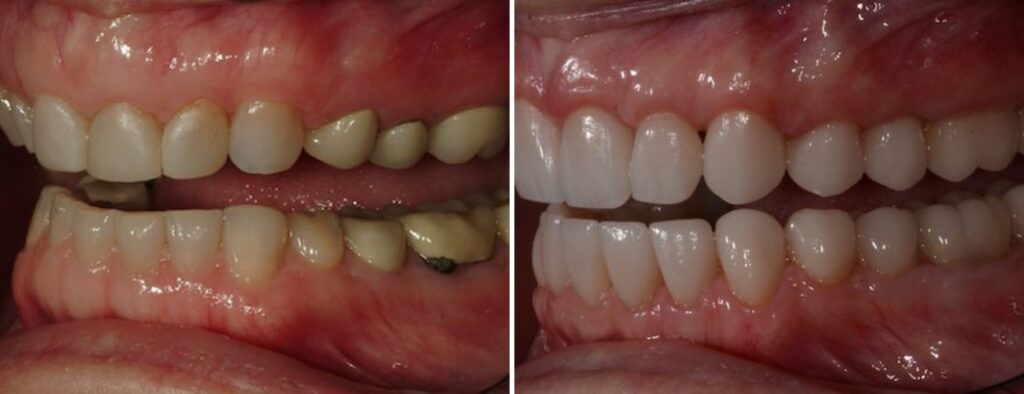 Dental patient before and after restorative dentistry at AH Smiles