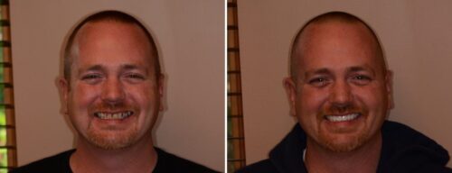 Results after dentistry at AH Smiles