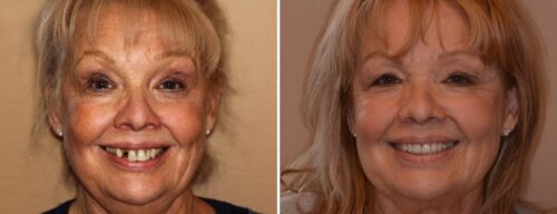 Results after dentistry at AH Smiles