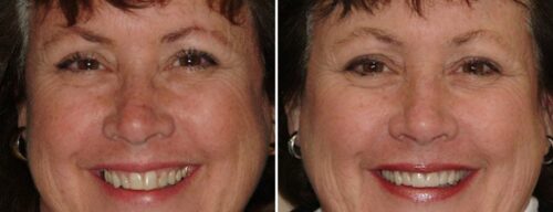 Results after dentistry at AH Smiles