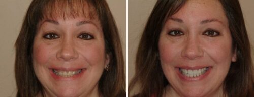 Results after dentistry at AH Smiles