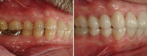 Results after dentistry at AH Smiles