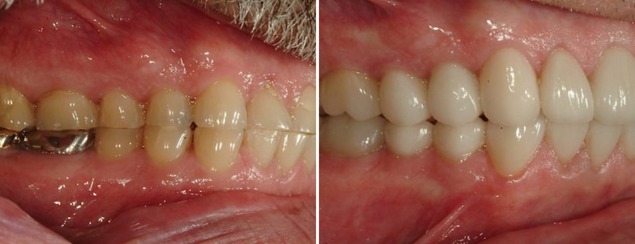 Patient before and after replacing single teeth with an implant