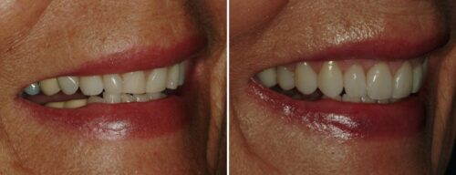 Results after dentistry at AH Smiles