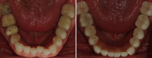 Results after dentistry at AH Smiles