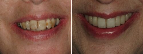 Results after dentistry at AH Smiles