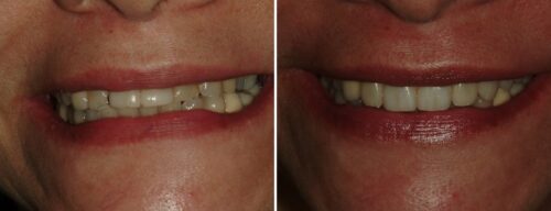 Results after dentistry at AH Smiles