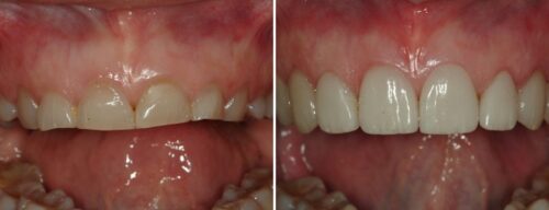 Results after dentistry at AH Smiles