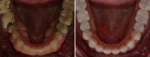 Results after dentistry at AH Smiles