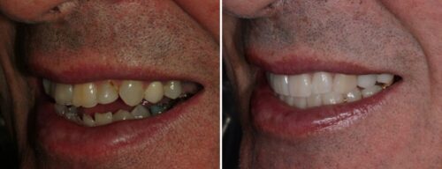 Results after dentistry at AH Smiles