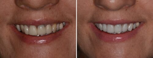 Results after dentistry at AH Smiles