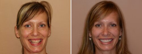 Results after dentistry at AH Smiles