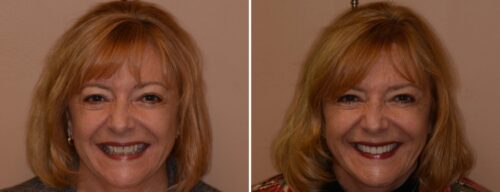 Results after dentistry at AH Smiles