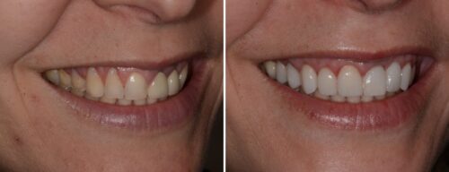 Results after dentistry at AH Smiles