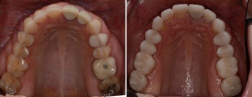 Results after dentistry at AH Smiles