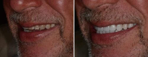 Results after dentistry at AH Smiles