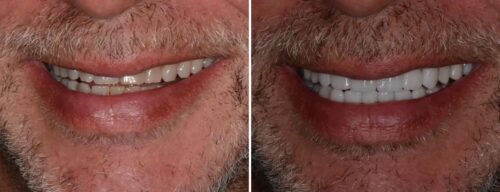 Results after dentistry at AH Smiles