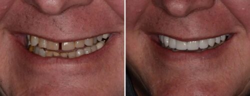 Results after dentistry at AH Smiles